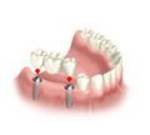 Ersatz mehrerer Zähne