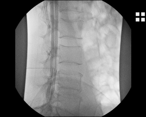 Myelographie / Myelo CT ǀ UKD