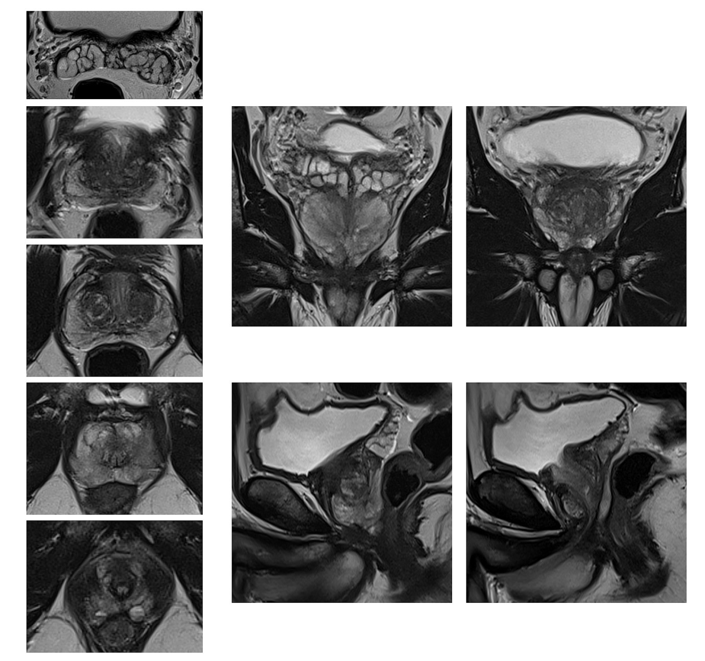 MRI lėtiniam prostatitui