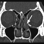 Chronische Rhinosinusitis