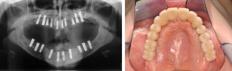 Komplette implantatgetragene festsitzender Zahnersatz im Ober- und Unterkiefer