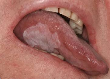 Leukoplakie am Zungenrand rechts: vor (links) und nach (rechts)