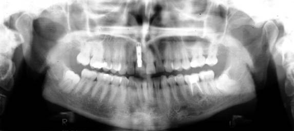 Horizontal und vertikal verlagerte Zähne 38/48 mit enger Lagebeziehung zum N. alveolaris inferior (Panoramaschichtaufnahme). Die Lage der Wurzeln zu den Nerven(38/48) ist nicht eindeutig beurteilbar.
