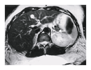 Abb.: Axiales, T1-gewichtetes Bild einer Magnetresonanztomographie des Abdomens. Durch die exzessive Fettansammlung ist die linke Nebenniere vollständig in adipösem Gewebe eingettet (Pfeil)